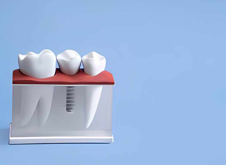 implantologija-teadent-prijedor